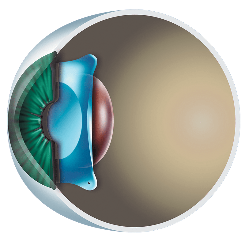 icl surgery malaysia