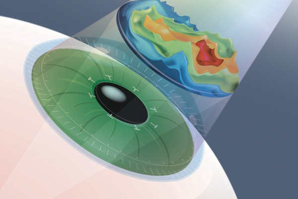 lasik malaysia